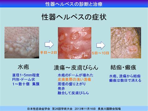 陰部生倉|男女陰部(生殖器)潰瘍及潰瘍症狀